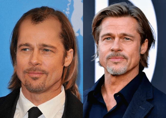 Male Celebrities Who Wear Toupees And Wigs Due To Hair Loss Kembeo